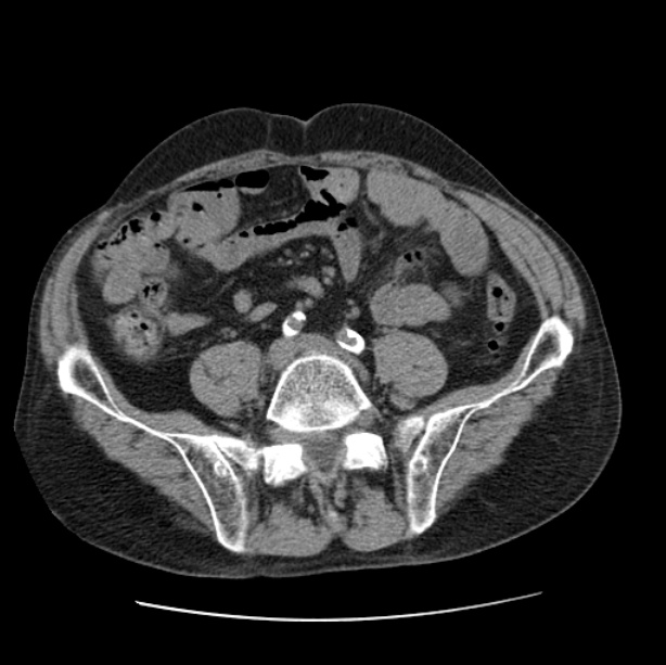 Autosomal dominant polycystic kidney disease (Radiopaedia 27851-28094 Axial non-contrast 89).jpg