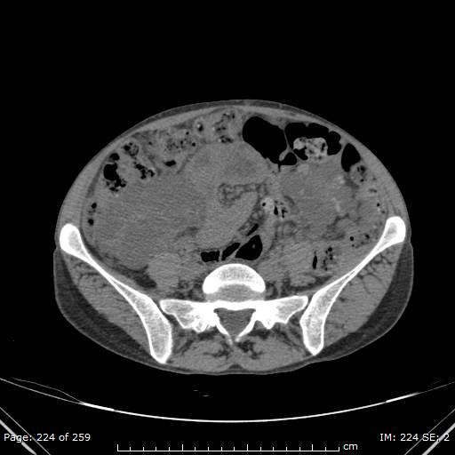 File:Autosomal dominant polycystic kidney disease (Radiopaedia 44122-47684 Axial 66).jpg