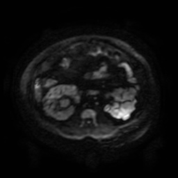 File:Autosomal dominant polycystic kidney disease (Radiopaedia 50259-55611 Axial DWI 96).jpg