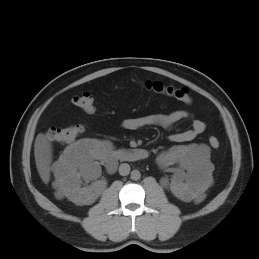 File:Autosomal dominant polycystic kidney disease (Radiopaedia 50259-55612 Axial non-contrast 40).jpg