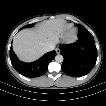 Autosomal dominant polycystic kidney disease (Radiopaedia 66349-75582 B 8).jpg