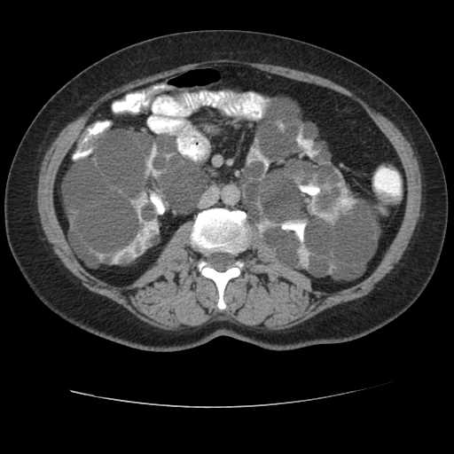 Autosomal dominant polycystic kidney disease with hepatic involvement (Radiopaedia 32693-33662 C 39).jpg