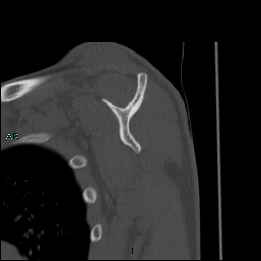 File:Avascular necrosis after fracture dislocations of the proximal humerus (Radiopaedia 88078-104653 Sagittal bone window 46).jpg