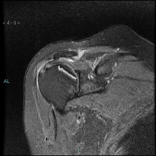File:Avascular necrosis of the shoulder - Cruess stage I (Radiopaedia 77674-89886 Coronal PD fat sat 9).jpg