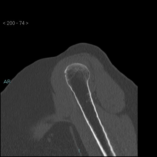 Avascular necrosis of the shoulder - Cruess stage I (Radiopaedia 77674-89887 Sagittal bone window 73).jpg