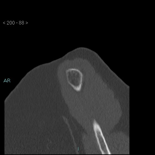 Avascular necrosis of the shoulder - Cruess stage I (Radiopaedia 77674-89887 Sagittal bone window 87).jpg