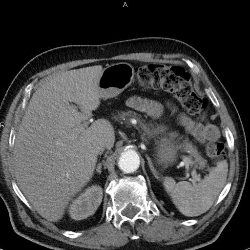 File:Azygos continuation of the inferior vena cava (Radiopaedia 18537-18404 C+ arterial phase 56).jpg