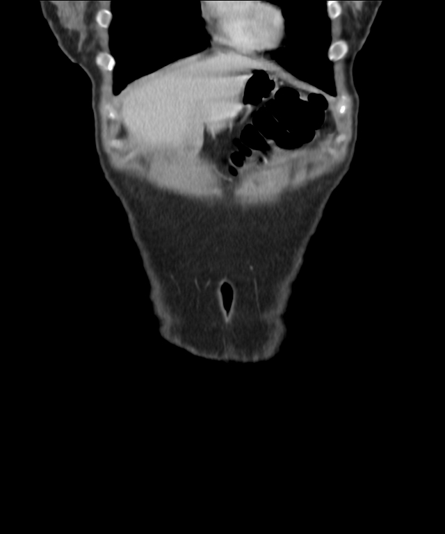 Azygos continuation of the inferior vena cava (Radiopaedia 70472-80592 B 1).jpg