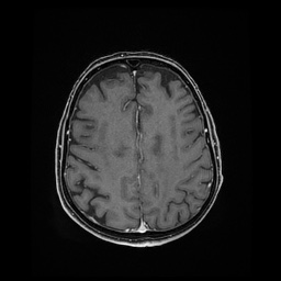 Balo concentric sclerosis (Radiopaedia 53875-59982 Axial LAVA C+ 181).jpg