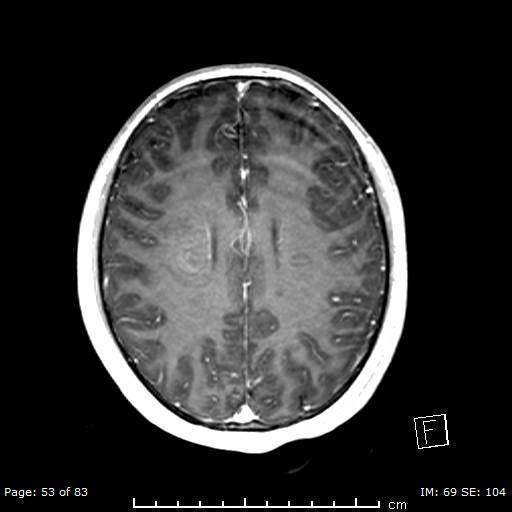 Balo concentric sclerosis (Radiopaedia 61637-69636 Axial T1 C+ 53).jpg