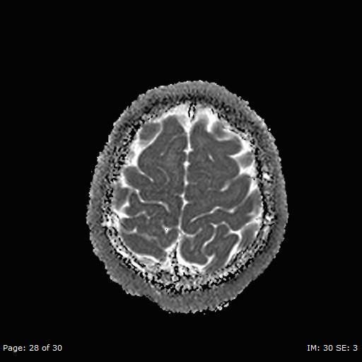 Balo concentric sclerosis (Radiopaedia 61637-69636 I 184).jpg