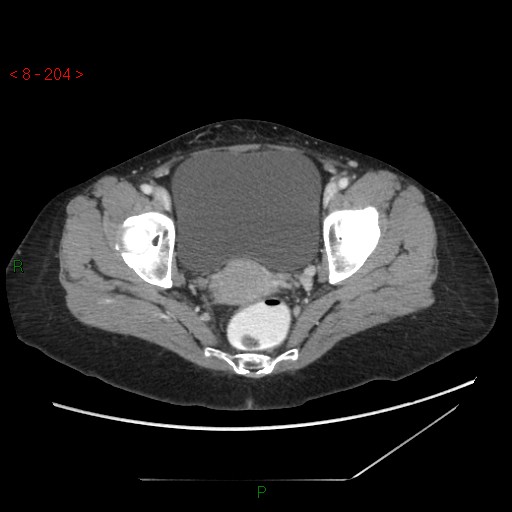 Bartholin gland cyst (Radiopaedia 54904-61181 A 51).jpg
