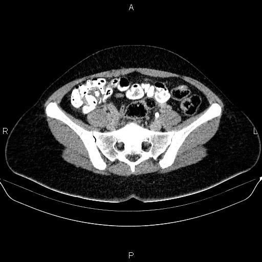 Bartholin gland cyst (Radiopaedia 62635-70930 C 23).jpg