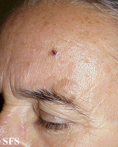 Basal Cell Carcinoma (Dermatology Atlas 105).jpg