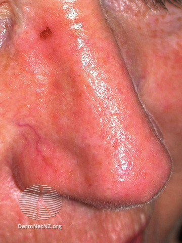 File:Basal cell carcinoma affecting the nose (DermNet NZ lesions-bcc-nose-0872).jpg