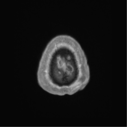 Basal ganglia metastasis (Radiopaedia 78928-91828 Axial T1 C+ 73).png