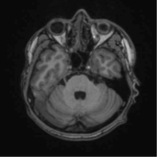 Basal ganglia subacute infarct (Radiopaedia 80201-93521 Axial T1 15).png