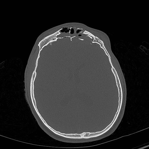 Base of skull fracture with bilateral Le Fort fractures (Radiopaedia 47094-51638 Axial bone window 55).jpg