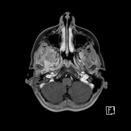 Base of skull rhabdomyosarcoma (Radiopaedia 32196-33142 T1 C+ fat sat 25).jpg