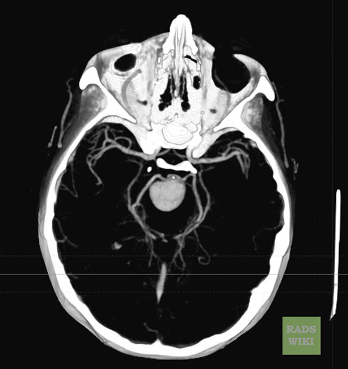 File:Basilar artery aneurysm (Radiopaedia 11533-11896 Axial MIP 1).jpg
