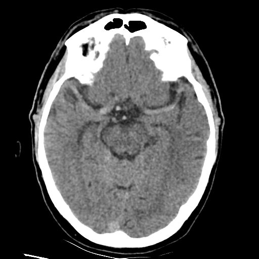 File:Basilar artery occlusion (Radiopaedia 33570-34659 Axial non-contrast 16).png