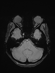 Basilar artery perforator aneurysm (Radiopaedia 82455-97733 Axial SWI 12).jpg