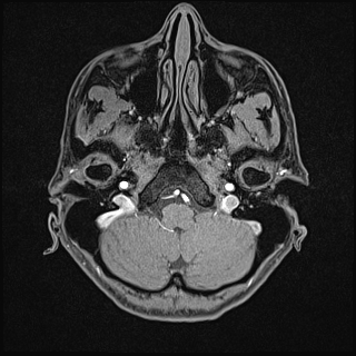 File:Basilar artery perforator aneurysm (Radiopaedia 82455-97733 Axial T1 fat sat 20).jpg