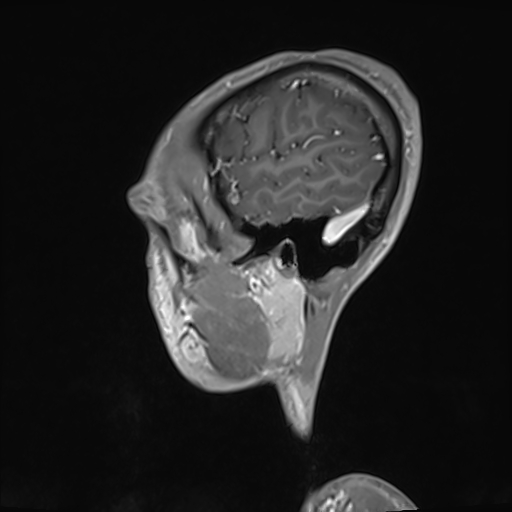 File:Basilar artery perforator aneurysm (Radiopaedia 82455-97733 G 129).jpg
