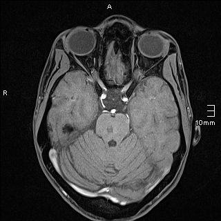 Basilar artery perforator aneurysm (Radiopaedia 82455-99523 F 46).jpg