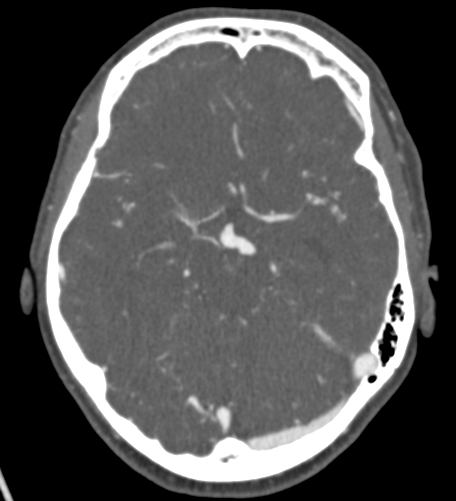 File:Basilar tip aneurysm with coiling (Radiopaedia 53912-60086 A 60).jpg