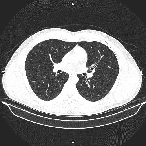 Beam hardening and ring artifacts (Radiopaedia 85323-100915 Axial lung window 38).jpg