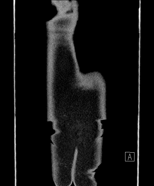 Benign colonic stricture with colo-colonic fistula (Radiopaedia 59439-66800 A 81).jpg