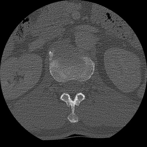 Benign post-traumatic pseudopneumoperitoneum (Radiopaedia 71199-81495 Axial bone window 188).jpg