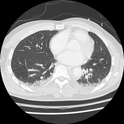 Benign post-traumatic pseudopneumoperitoneum (Radiopaedia 71199-81495 Axial lung window 45).jpg