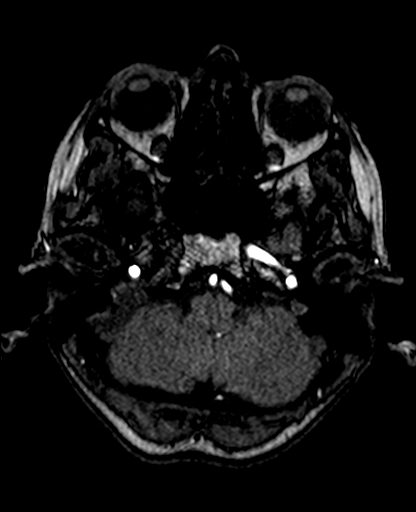 Berry aneurysm of the terminal internal carotid artery (Radiopaedia 88286-104918 Axial TOF 62).jpg