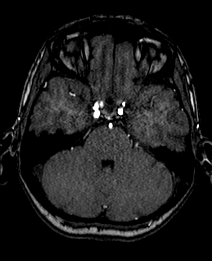 Berry aneurysm of the terminal internal carotid artery (Radiopaedia 88286-104918 Axial TOF 87).jpg