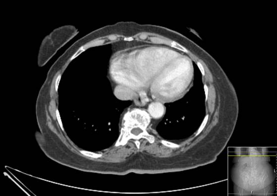Bicameral celiacomesenteric aneurysm (Radiopaedia 55766-62327 A 1).jpg