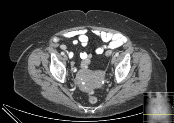 Bicameral celiacomesenteric aneurysm (Radiopaedia 55766-62327 A 61).jpg