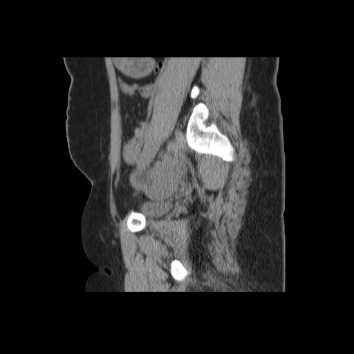 File:Bicornuate uterus- on MRI (Radiopaedia 49206-54296 A 5).jpg