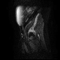 File:Bicornuate uterus (Radiopaedia 51676-57472 Sagittal DWI 1).jpg