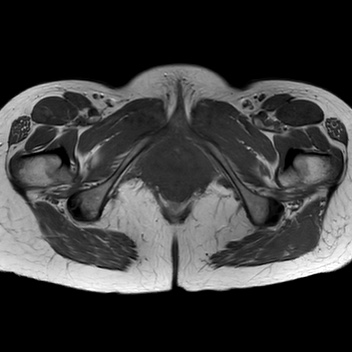 File:Bicornuate uterus (Radiopaedia 61974-70046 Axial T1 42).jpg