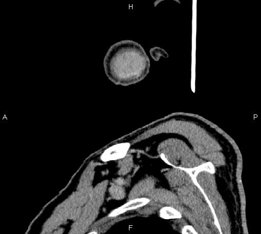 Bilateral Warthin tumors (Radiopaedia 84034-99263 D 74).jpg