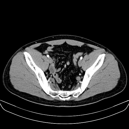 Bilateral accessory renal arteries with mild pelvi-ureteric junction (PUJ) obstruction (Radiopaedia 66357-75596 A 59).jpg