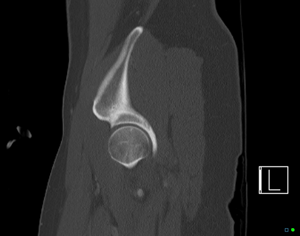 Bilateral acetabular fractures (Radiopaedia 79272-92308 Sagittal bone window 16).jpg