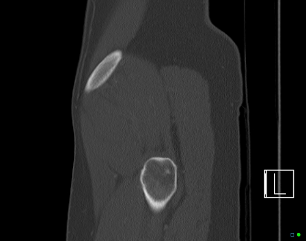 Bilateral acetabular fractures (Radiopaedia 79272-92308 Sagittal bone window 83).jpg
