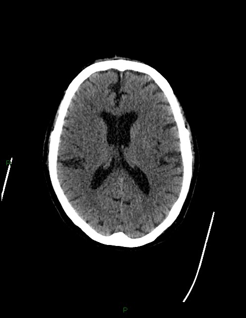Bilateral acute middle cerebral artery territory infarcts (Radiopaedia 77319-89401 Axial non-contrast 50).jpg