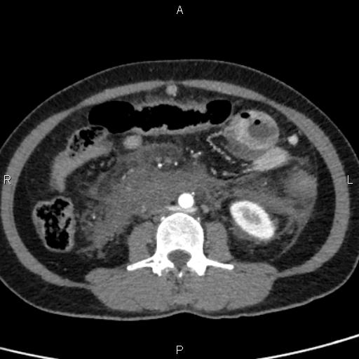 Bilateral adrenal gland hyperenhancement in pancreatitis (Radiopaedia 86642-102753 B 76).jpg