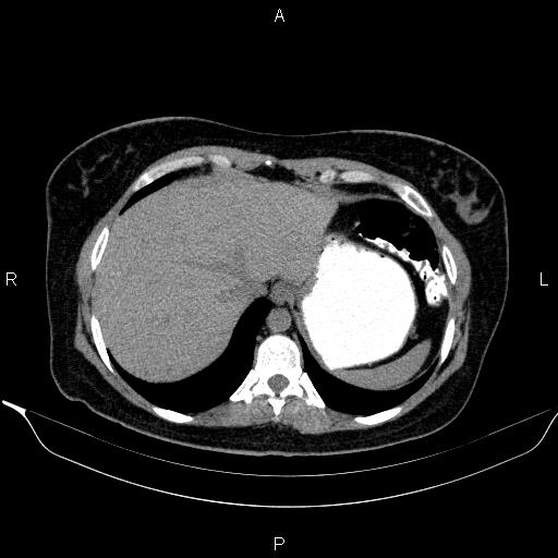 Bilateral adrenal myelolipoma (Radiopaedia 63058-71535 Axial non-contrast 20).jpg