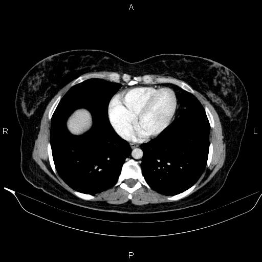 File:Bilateral adrenal myelolipoma (Radiopaedia 63058-71535 B 4).jpg