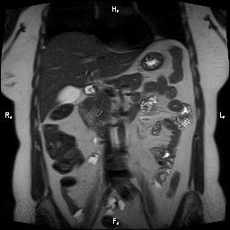 File:Bilateral adrenal myelolipoma (Radiopaedia 63058-71537 Coronal T2 19).jpg